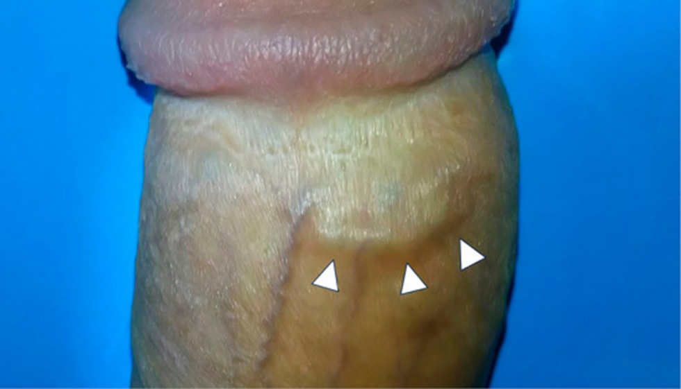 Penile-Mondor’s-disease.jpg