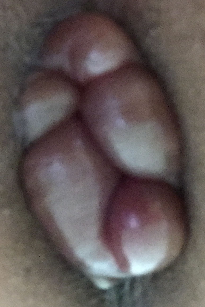 내항문.JPG